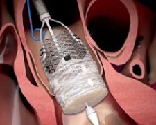 Boston Scientific Lotus Valve System | Used in Transcatheter aortic valve implantation (TAVI)  | Which Medical Device